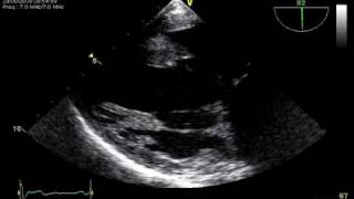 3 RUPTURE CHORDAE TRANSGASTRIC TOE VIEW MITRAL REGURGITATION [upl. by Okiram]