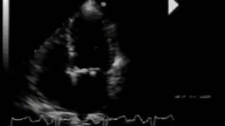 calcific aortic stenosismitral annular calcification and flail mitral valve 22 [upl. by Selden]