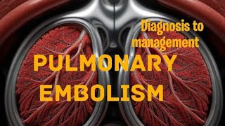 Pulmonary embolism  From Diagnosis to management [upl. by Annmarie]