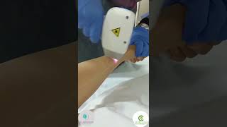 épilation laser Fès laser Arrazi [upl. by Cressi]