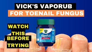 Vicks Vaporub for Nail Fungus  Toe Fungus Journey [upl. by Ahserb]