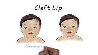 Getting Started Feeding Your Baby with Cleft Lip andor Cleft Palate [upl. by Atiner842]