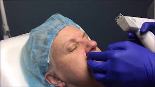 Profound RF Plus NonSurgical Skin Tightening [upl. by Nuyh641]