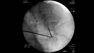 COOLIEF Lumbar Cooled RF Training Presentation [upl. by Langan]