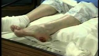 Pressure Ulcers  Soft Tissue Compression  Wound Care Education [upl. by Karame]