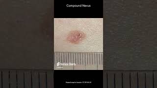 Compound Nevus [upl. by Deste]