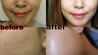 HOW TO GET CLEAR SKIN SOME BY MI REVIEW DOES IT WORK [upl. by Norabel225]