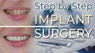 Dental Implant Surgery  Step by Step 27 Extraction and Ridge Preservation [upl. by Chaim346]