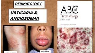 DERMATOLOGY  URTICARIA amp ANGIOEDEMA derma urticaria angioedema [upl. by Akenot]