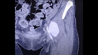 IV Drug User IVDU complications  pseudoaneurysm arterial occlusions stenoses and phlegmon [upl. by Cavil958]