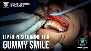 Lip Repositioning Surgery For Gummy Smile Case Study  Narrated by Dr Omer Karaaslan [upl. by Macomber]