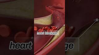 हार्ट अटैक से पहले करे ये 2 काम 2 SIMPLE STEPS to prevent a HEART ATTACK [upl. by Kurt]