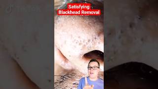 Crazy BLACKHEAD REMOVAL  Blackhead Extraction shorts [upl. by Ecilahc]