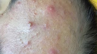 inflamed forehead and cheek acne  dermacool 0217 [upl. by Nenney540]