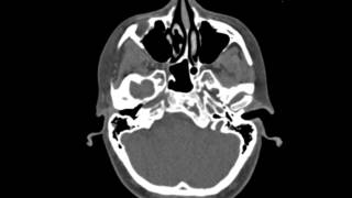 Fibrous Dysplasia Clivus [upl. by Penni]