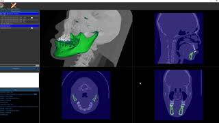 Deep learning based CT Segmentation mandible Demo [upl. by Rubetta]