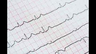 ecg interpretation made easy [upl. by Leuams]