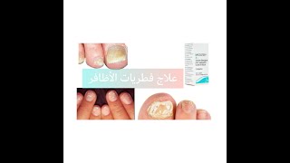 علاج فطريات الأظافر [upl. by Aneleairam]