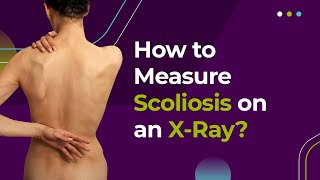 How to Measure Scoliosis on an XRay [upl. by Luke]