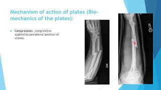 Orthopedic Trauma  general principles 1 [upl. by Acceb]