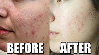 ACNE CHEMICAL PEEL BEFORE AND AFTER 1 TREATMENT JOURNEY TO CLEAR SKIN [upl. by Ingold108]