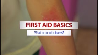 Basic first aid treatment for burns [upl. by Kryska]