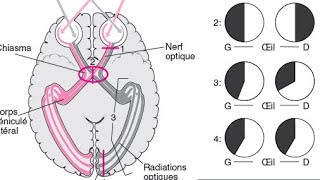 🔺Champ viseul  voies optiques  lésions optiques [upl. by Romito175]