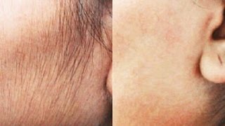 Remove Hair Permanently At Home Natural DIY  Face amp Upper Lip  SuperWowStyle [upl. by Thierry186]