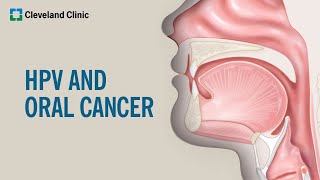 What Is HPVRelated Oral Cancer [upl. by Aubin]