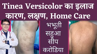 Tinea Versicolar Treatment  भभूतीसीपसहुआकरोडिया का इलाज  Pityriasis Versicolor  In Hindi [upl. by Enimzaj]