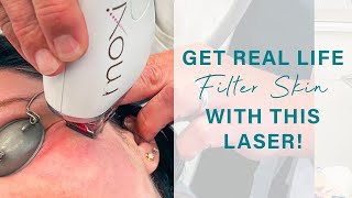 The Laser that gives you Filter Skin  MOXI Laser [upl. by Anastatius]