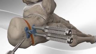 Flatfoot Repair with Arthrex® Calcaneus Step Plate [upl. by Saville]