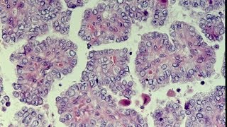 Thyroid Neoplasms  Pathology mini tutorial [upl. by Arocal]