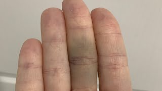 how to get rid of a bruised finger in 5 minutes [upl. by Aynotan]