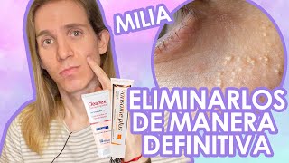 TRATAMIENTO de QUISTES DE MILLIUM o MILIA ¿Cómo eliminarlos Tratamiento Dermatologico [upl. by Yellehs378]