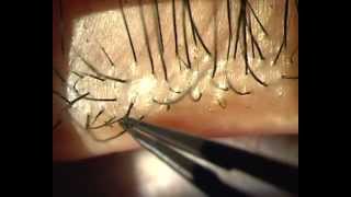 Demodex Blepharitis  Is it for real [upl. by Kcirad760]