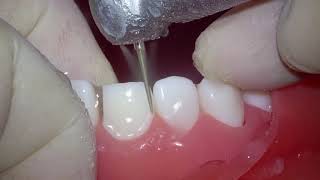 상악 전치부 PFM crown 을 위한 치아삭제 실습 11 tooth preparation for PFM crown [upl. by Currier]