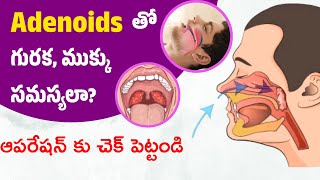 Adenoids Causes amp Treatment Telugu  Medi9 Hospitals  Natural remedies [upl. by Rico]