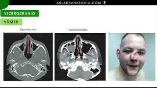 OSSO VOMER fisioterapia medicina anatomy anatomia odontologia odonto ossos neurociencia [upl. by Idnim]