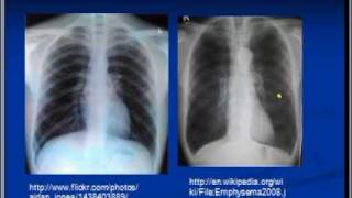 Chest xray interpretation COPD and Emphysema [upl. by Michaud656]