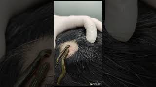 Leech Therapy for Alopecia Aerata unani leeching alopecia ganjapan Uniwell [upl. by Emelita]