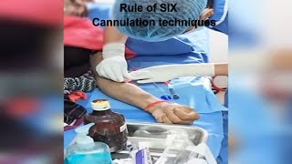 AVF Cannulation techniques  Dialysis patient cannulation dcdc ttt [upl. by Ranite]