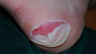 Blister Treatments 5 Natural Ways to Treat Foot Blisters  By Top 5 [upl. by Dlaregztif]