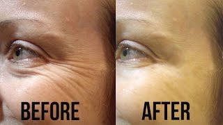 How to Get Rid of Age Spots Naturally [upl. by Acired]