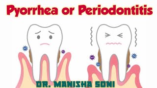 Pyorrhea  Periodontitis  Causes  Symptoms  Treatment [upl. by Chastity674]