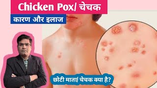 Chicken Pox Disease  Cause Symptoms and Treatment  Vaccine  चेचक का इलाज [upl. by Yrrak]