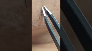 Satisfying Tweezing Extremely Stubborn Facial Hairs [upl. by Pamela145]