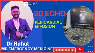 PERICARDIAL EFFUSION2D ECHOAIIMSNEWDELHI [upl. by Yekram]