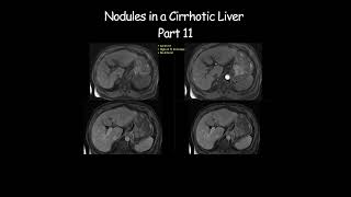 Nodules in a Cirrhotic Liver  Part 11 radiology radiologist cirrhosis liverdisease liverhealth [upl. by Nicoline]