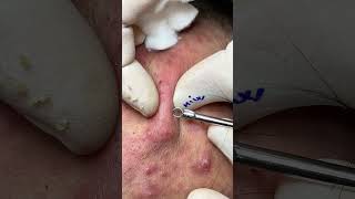 The Battle Against FullFace Infected Acne A Meticulous Extraction Process [upl. by Plantagenet]